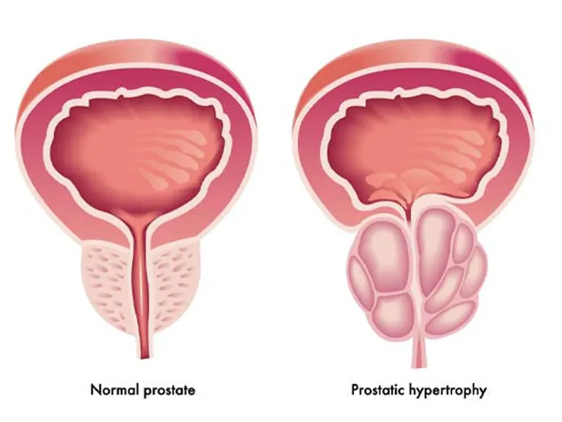 پروستاتیت